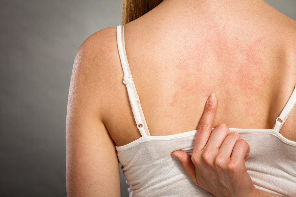 Health problem, skin diseases\. Young woman showing her itchy back with allergy rash urticaria symptoms